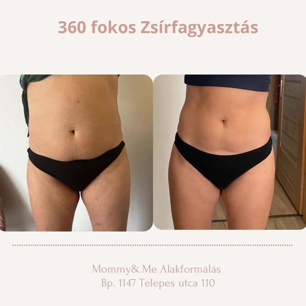 360 fokos zsírfagyasztás előtte-utána – has és derék, Mommy & Me Budapest
