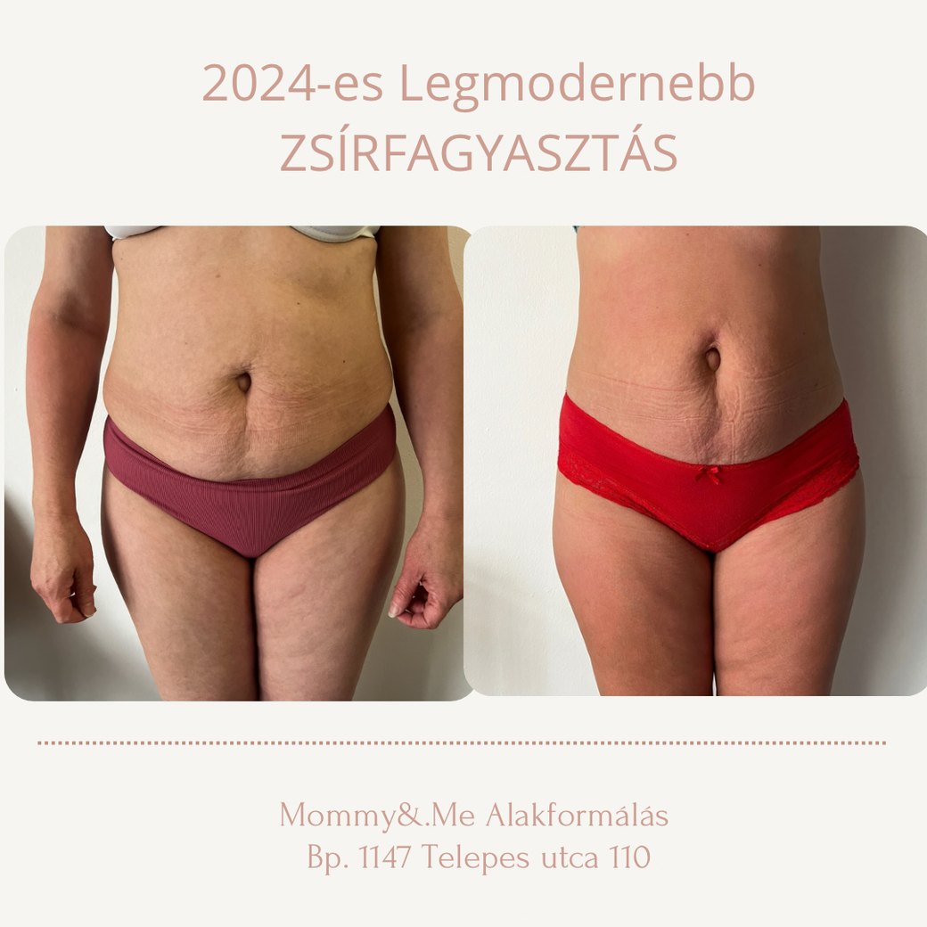 Zsírfagyasztás előtte-utána eredmény – has elölnézet, Mommy & Me Budapest