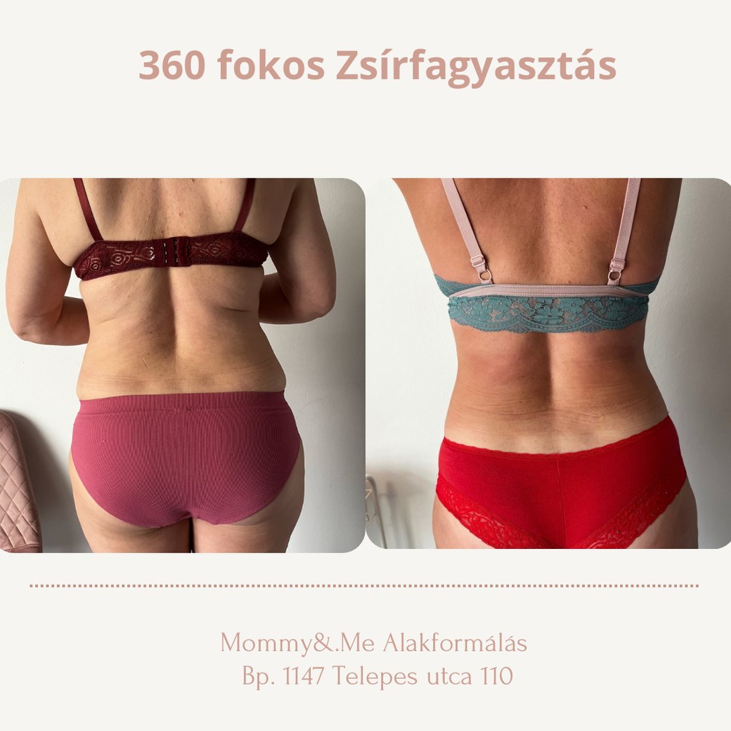 Zsírfagyasztás előtte-utána – hát és deréktáj hátulnézet, Mommy & Me Budapest
