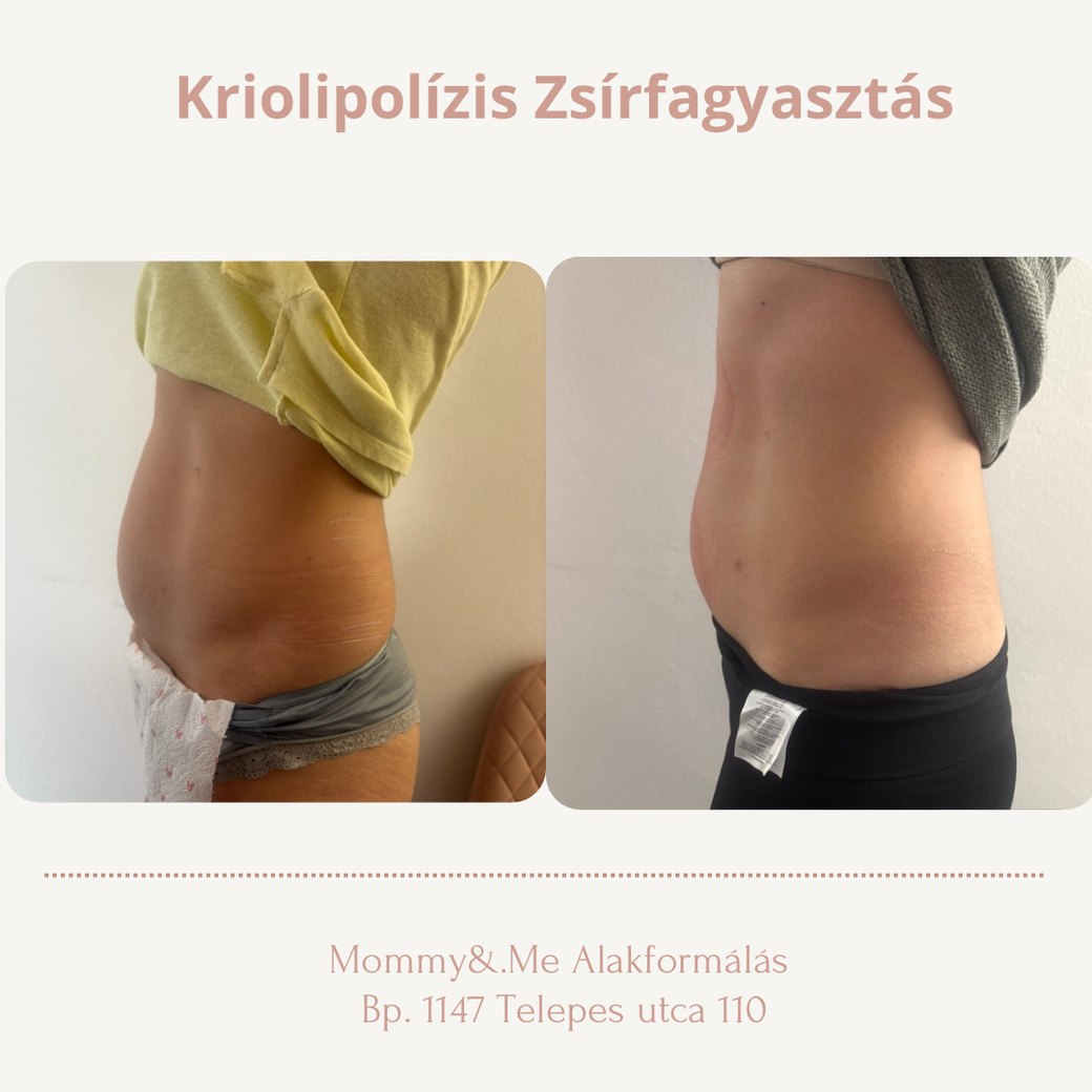 Kriolipolízis zsírfagyasztás előtte-utána – has oldalnézet, Mommy & Me Budapest