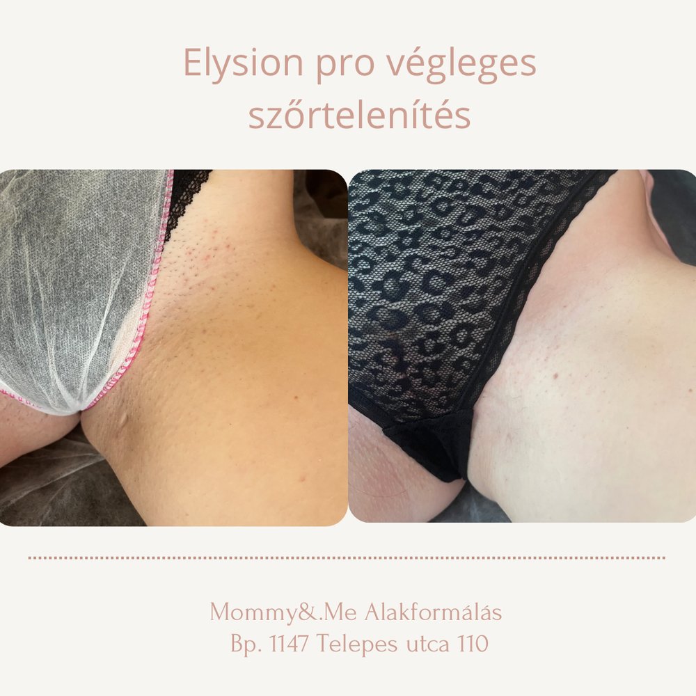 Lézeres szőrtelenítés előtte-utána – bikini vonal, Mommy & Me Budapest