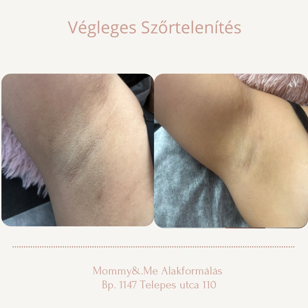 Lézeres szőrtelenítés előtte-utána – hónalj, Mommy & Me Budapest